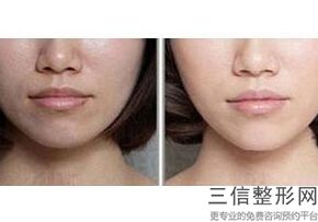 北京热玛吉认证医院排行榜前五名单查看,热玛吉认证医生和认证医院