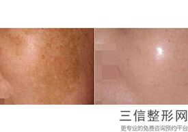 北京三甲医院拉皮整形排名表前十推荐,北京哪家医院做拉皮手术好