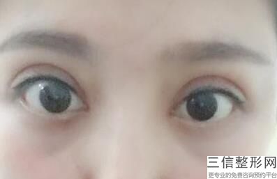 北京三甲医院做双眼皮排名表前十多方面查询,北京三甲医院 双眼皮