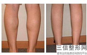 北京手臂吸脂医院排名前十公布,北京吸脂专科医院