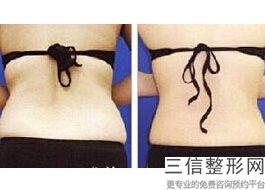 北京手臂吸脂医院排名前十公布,北京吸脂专科医院