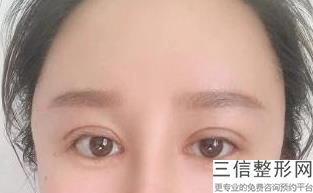北京双眼皮医生排名榜十个四个坐诊八大处,北京做双眼皮比较有名的医生
