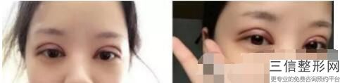 北京双眼皮医生排名榜十个四个坐诊八大处,北京做双眼皮比较有名的医生