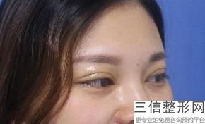 北京双眼皮医院排行前十权威发布,北京哪家医院做双眼皮比较好的医院