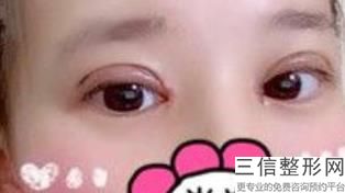 北京双眼皮医院排行前十权威发布,北京哪家医院做双眼皮比较好的医院