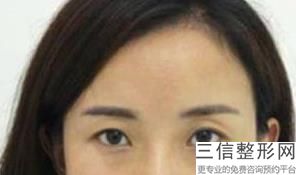 北京双眼皮整容医院哪家好,北京割双眼皮医院排名