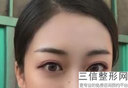 北京双眼皮整容医院哪家好,北京割双眼皮医院排名