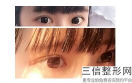 北京双眼皮整形医院排名榜top5公布,北京哪家整形医院做双眼皮比较好