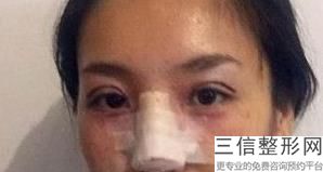 北京双眼皮整形医院排名表五强详情,北京做双眼皮医院排行榜