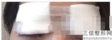 北京双眼皮整形医院排名表五强详情,北京做双眼皮医院排行榜