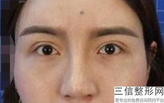 北京双眼皮整形医院排名表五强详情,北京做双眼皮医院排行榜