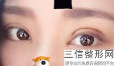 北京双眼皮整形医院排名前五的,北京割双眼皮良好的医院是哪家
