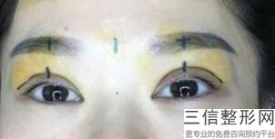 北京眼部综合整形医院排名榜六强更新,眼部整形医院排名前十