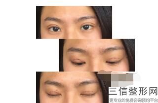 北京整形双眼皮医院排名榜top5年中探店,北京正规割双眼皮医院哪家良好