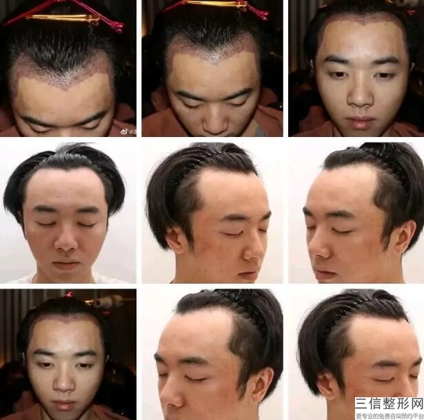 北京植发公立医院排行前三权威盘点,北京权威植发医院排名