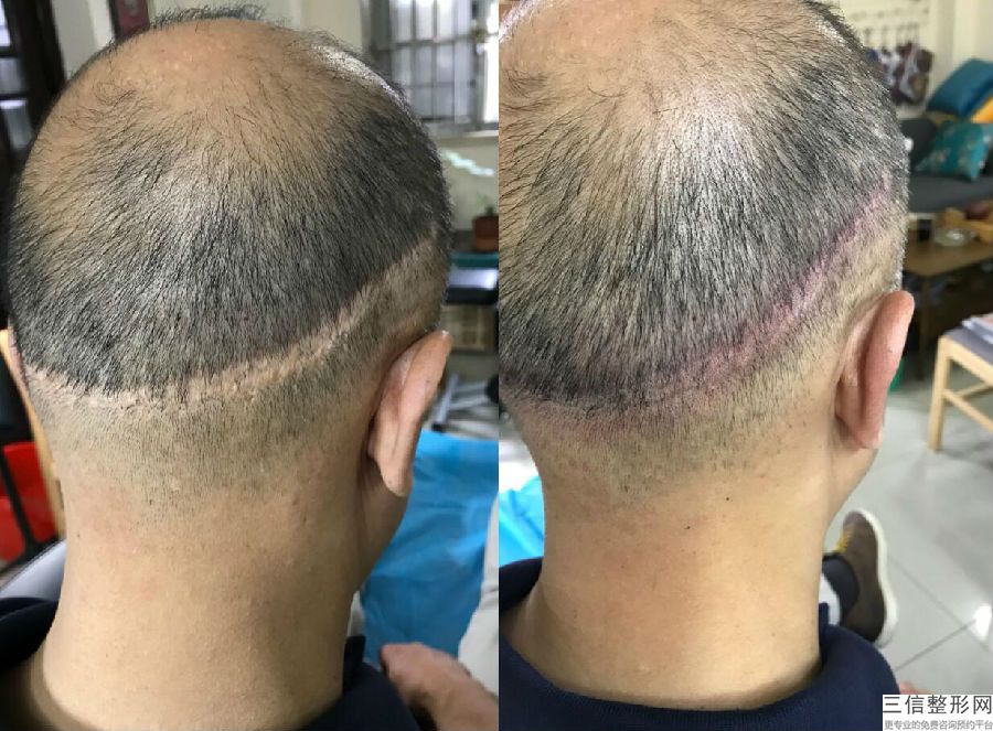 北京植发三甲医院排名榜前六强良心推荐,北京有哪些三甲的植发医院
