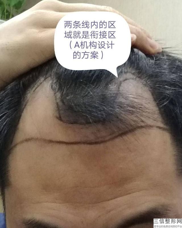 北京植发三甲医院排名实力评出,全国植发三甲医院排名