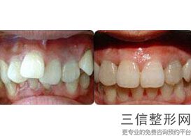 北京种植牙三甲医院排名榜靠前名单有北大口腔,北京哪个医院种植牙比较好