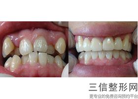 北京种植牙三甲医院排名榜靠前名单有北大口腔,北京哪个医院种植牙比较好