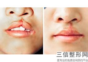 北京嘴部整形医院排名前六权威点评,嘴巴整形医院