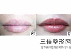 北京嘴部整形医院排名前六权威点评,嘴巴整形医院