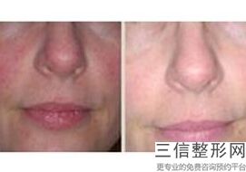 北京做隆鼻有名的医生推荐,北京做隆鼻良好的医生