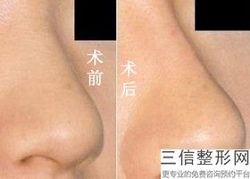 北京做隆鼻有名的医生推荐,北京做隆鼻良好的医生