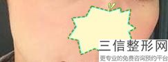 北京做隆胸比较好的医生排行榜五强揭秘,北京隆胸良好的医院