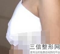 北京做隆胸美容整形医院排行榜前十强,隆胸哪家整形医院好