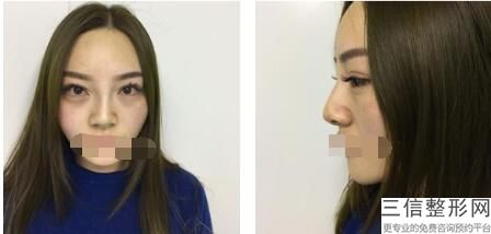 鼻王排名专家揭晓前四强,国内鼻综合十大专家