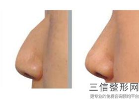 鼻王排名专家揭晓前四强,国内鼻综合十大专家