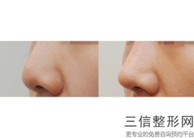 常州做鼻子整形医院前五vs前三,常州鼻部整形医院