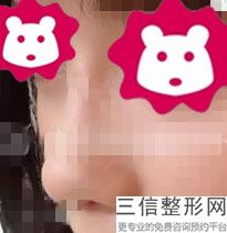 成都鼻子整形医院排行榜前五权威推荐,成都哪个医院整鼻子好