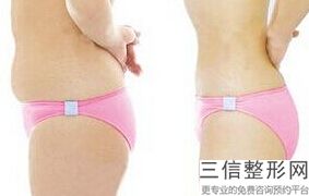 成都大腿抽脂医院排名榜有变化,成都抽脂医院排名前十