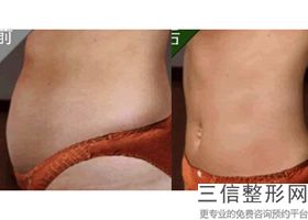 成都大腿抽脂医院排名榜有变化,成都抽脂医院排名前十