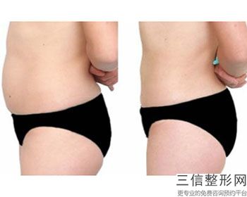 成都大腿抽脂医院排名榜有变化,成都抽脂医院排名前十