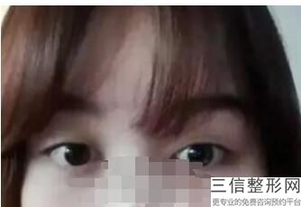 成都割双眼皮十强医院名单汇总,成都割双眼皮前10的医生