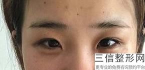 成都割双眼皮医院排行前十全新名单,成都割双眼皮良好的三甲医院