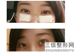 成都割双眼皮医院排名榜前六口碑盘点,成都名次靠前的割双眼皮医院