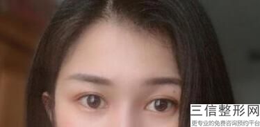 成都割双眼皮医院排名榜前六口碑盘点,成都名次靠前的割双眼皮医院