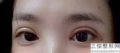 成都割双眼皮医院排名榜前六口碑盘点,成都名次靠前的割双眼皮医院