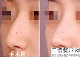 成都假体隆鼻整形医院排名前四汇总,成都假体隆胸医院推荐