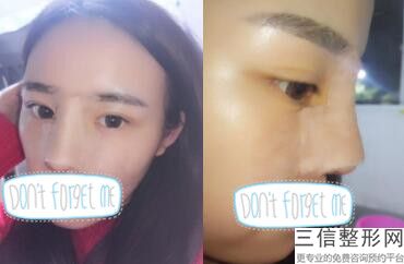成都军大隆鼻怎么样,成都军大整形是正规医院吗