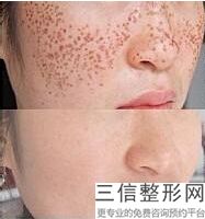 成都拉皮手术好的整形医院排名前五,成都拉皮手术良好的整形医院