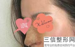 成都隆鼻医院排名前五权威公布,成都哪家医院隆鼻子良好的医院
