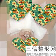 成都隆鼻医院排名前五权威公布,成都哪家医院隆鼻子良好的医院