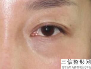 成都哪家公立医院做双眼皮好,成都公立医院割双眼皮良好的