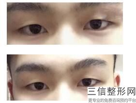 成都去眼袋三甲医院哪家好,成都去眼袋哪个医生好