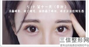 成都去眼袋三甲医院哪家好,成都去眼袋哪个医生好