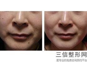 成都热玛吉官方授权医院公布前十,成都热玛吉哪家好